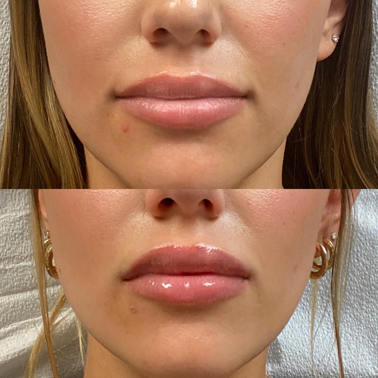 Everything You Need to Know About Fillers and Botox: Your Guide to Non-Surgical Beauty Enhancements